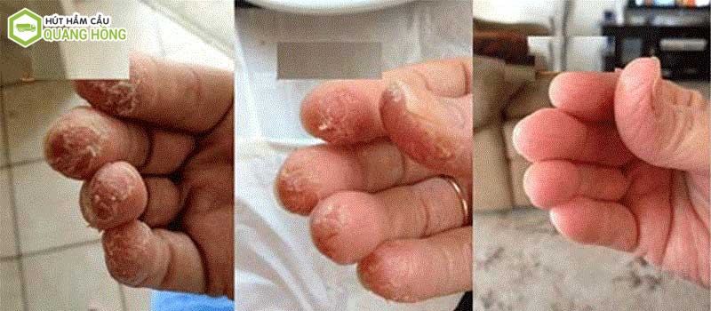 Tác hại bột thông cống phải đeo găng tay